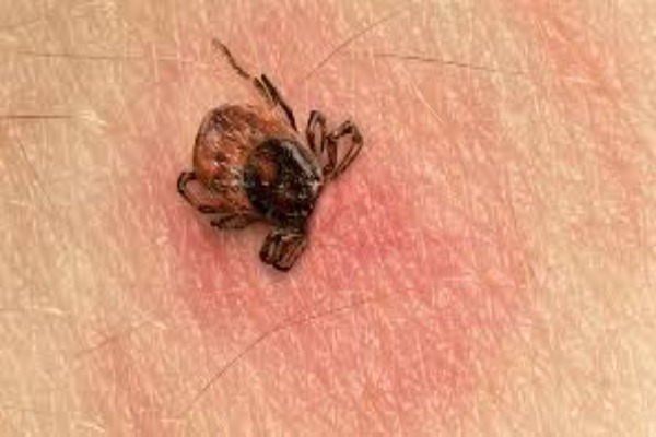 Kene Isırığında Ne Yapılmalı? Belirtiler ve Ne Zaman Doktora Başvurulmalı?